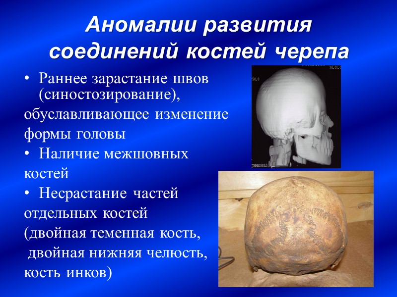 Аномалии развития соединений костей черепа Раннее зарастание швов (синостозирование),  обуславливающее изменение  формы